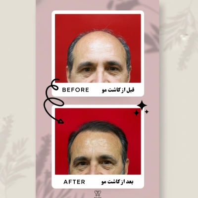 نمونه کار واقعی کاشت مو در کلینیک فوق تخصصی مو .webp